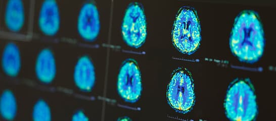 Two brain scan images side by side on a clinical lightbox.